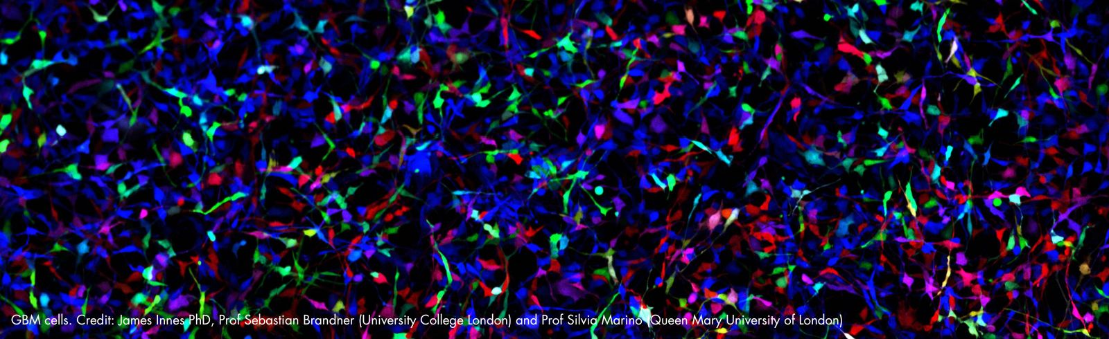 Discovery opens doors for potential new GBM treatments – Brain