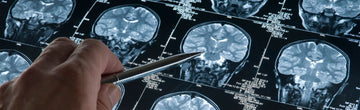 What is an oligodendroglioma?