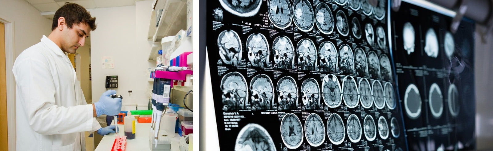 Blog: How whole genome sequencing can improve brain tumour treatment