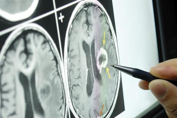 Immunotherapy helps GBM patients whose tumours had grown back – Brain Tumour Research